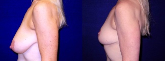 Left Profile View - Breast Lift After Pregnancy