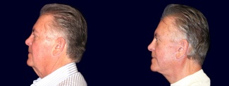 Left Profile View - Facelift, Eyelid Surgery, & Browlift