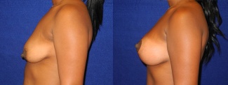 Left Profile View - Breast Augmentation with Lift After Pregnancy