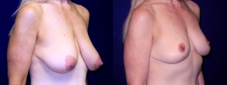 Right 3/4 View - Breast Lift After Pregnancy