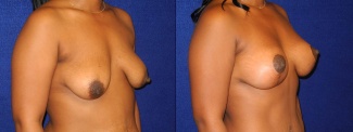 Right 3/4 View - Breast Augmentation with Lift After Pregnancy