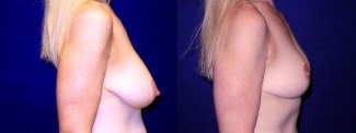 Right Profile View - Breast Lift After Pregnancy
