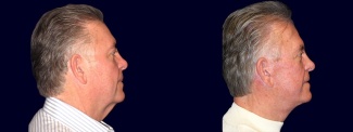 Right Profile View - Facelift, Eyelid Surgery, & Browlift