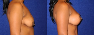 Right Profile View - Breast Augmentation with Lift After Pregnancy