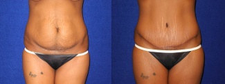 Frontal View - Tummy Tuck After Pregnancy