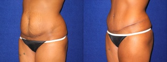 Left 3/4 View - Tummy Tuck After Pregnancy