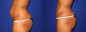 Left Profile View - Tummy Tuck After Pregnancy