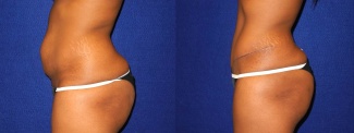 Left Profile View - Tummy Tuck After Pregnancy