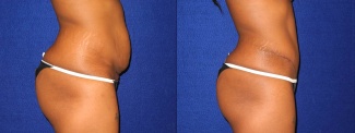 Right Profile View - Tummy Tuck After Pregnancy