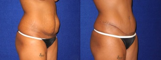 Right 3/4 View - Tummy Tuck After Pregnancy