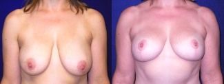 Frontal View - Breast Lift After Pregnancy & Weight Loss
