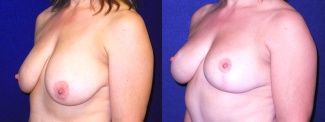 Left 3/4 View - Breast Lift After Pregnancy & Weight Loss