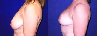 Left Profile View - Breast Lift After Pregnancy & Weight Loss
