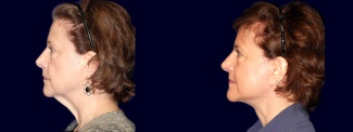 Left Profile View - Lower Facelift