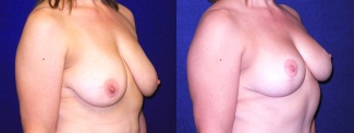 Right 3/4 View - Breast Lift After Pregnancy & Weight Loss