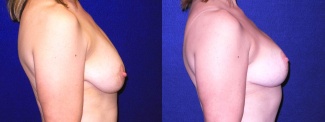 Right Profile View - Breast Lift After Pregnancy & Weight Loss