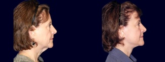 Right Profile View - Lower Facelift