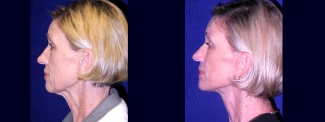 Left Profile View - Lower Facelift