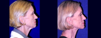 Right Profile View - Lower Facelift