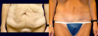 Frontal View - Tummy Tuck After Massive Weight Loss