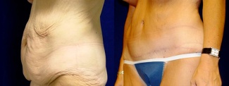 Left 3/4 View - Tummy Tuck After Massive Weight Loss