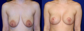 Frontal View - Breast Augmentation with Lift