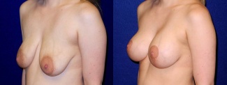 Left 3/4 View - Breast Augmentation with Lift