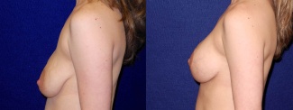 Left Profile View - Breast Augmentation with Lift