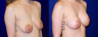 Right 3/4 View - Breast Augmentation with Lift
