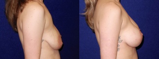 Right Profile View - Breast Augmentation with Lift