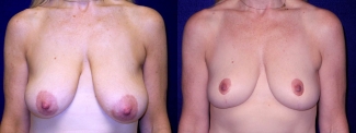 Frontal View - Breast Lift After Pregnancy