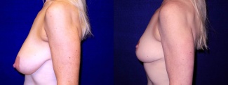 Left Profile View - Breast Lift After Pregnancy