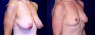 Right 3/4 View - Breast Lift After Pregnancy
