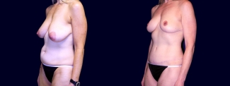 Left 3/4 View - Breast Lift & Tummy Tuck After Pregnancy
