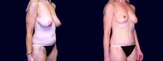 Right 3/4 View - Breast Lift & Tummy Tuck After Pregnancy