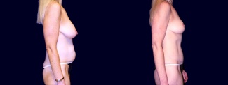Right Profile View - Breast Lift & Tummy Tuck After Pregnancy