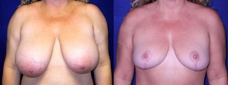 Frontal View - Breast Reduction After Pregnancy