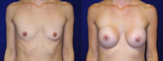 Frontal View - Breast Augmentation