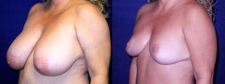 Left 3/4 View - Breast Reduction After Pregnancy