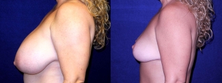 Left Profile View - Breast Reduction After Pregnancy