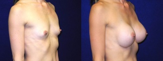 Right 3/4 View - Breast Augmentation