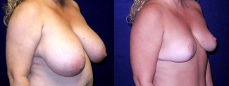 Right 3/4 View - Breast Reduction After Pregnancy