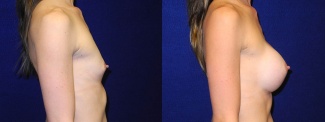 Right Profile View - Breast Augmentation