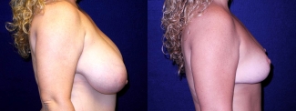 Right Profile View - Breast Reduction After Pregnancy