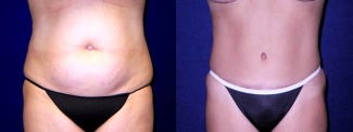 Frontal View - Tummy Tuck After Pregnancy