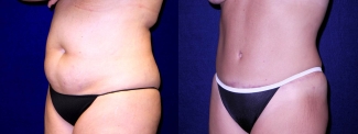 Left 3/4 View - Tummy Tuck After Pregnancy