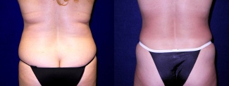 Back View - Tummy Tuck After Pregnancy