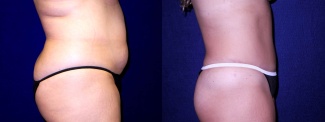 Right Profile View - Tummy Tuck After Pregnancy