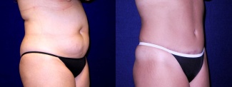 Right 3/4 View - Tummy Tuck After Pregnancy