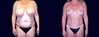 Frontal View - Breast Reduction and Tummy Tuck After Pregnancy